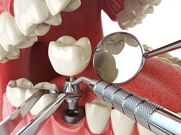 Best Knocked-Out Tooth (Avulsed Tooth) Treatment in Mays Chapel, MD
